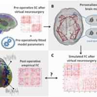 tumor_resection_brain_modelling.jpg